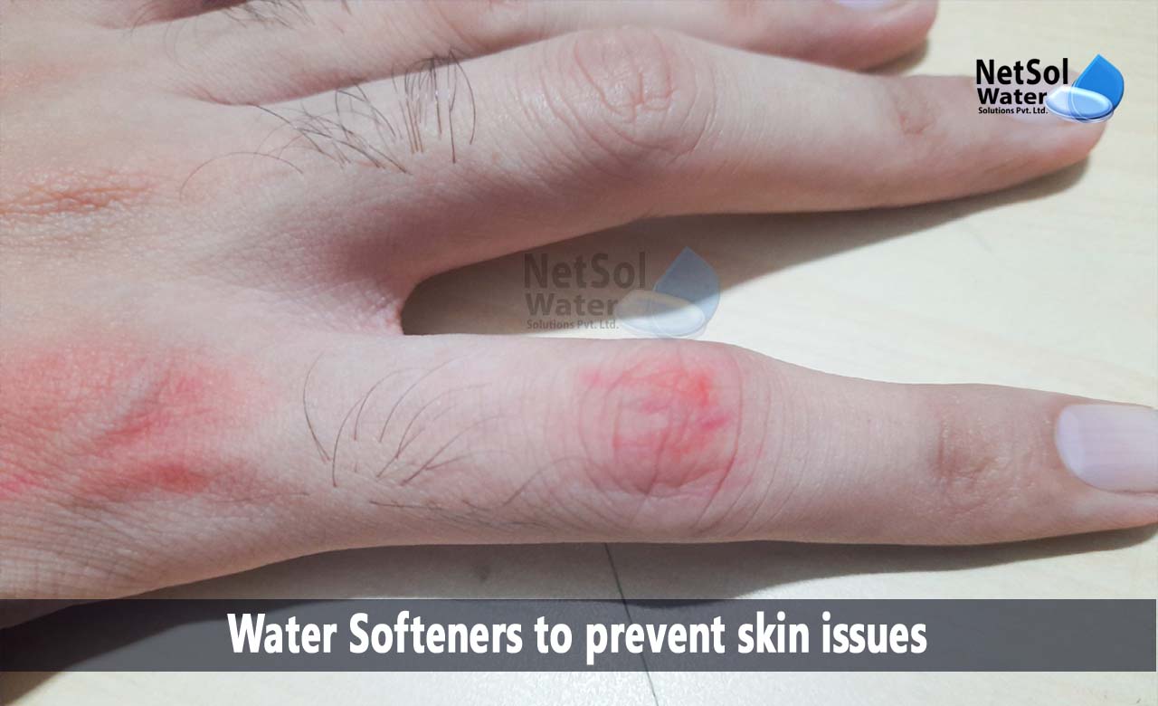 water softener skin problems, how to protect skin from hard water, Water Softeners to prevent skin issues